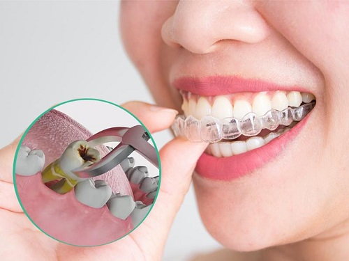 Niềng răng invisalign có nhổ răng không? Tìm hiểu tại nha khoa 3