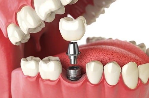 Trồng răng có chân răng khắc phục như thế nào? 3 Trồng răng có chân răng khắc phục như thế nào? 3