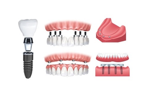 Trồng răng giả hàm dưới - Phương pháp phục hình hiệu quả 3