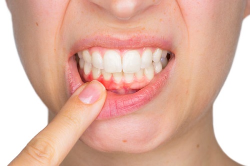Niềng răng bị viêm lợi - Nguyên nhân do đâu? 2
