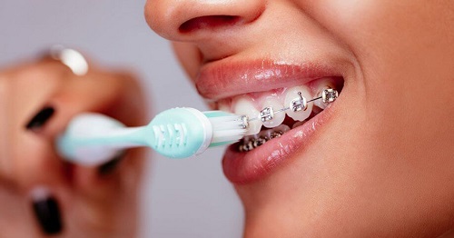 Niềng răng dùng bàn chải gì dễ dàng vệ sinh? 2