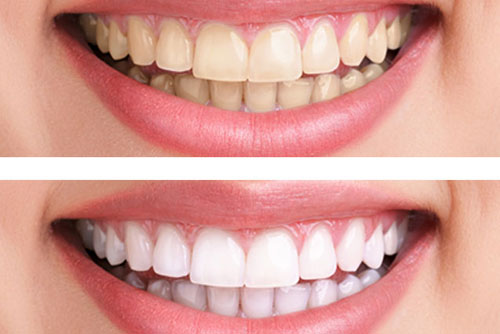 Cách tẩy trắng răng bị ố vàng tại nhà 3 Cách tẩy trắng răng bị ố vàng tại nhà 3