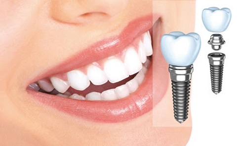 Kinh nghiệm làm răng implant bổ ích cho bạn 1