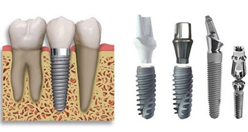 Kinh nghiệm làm răng implant bổ ích cho bạn 3 Kinh nghiệm làm răng implant bổ ích cho bạn 3