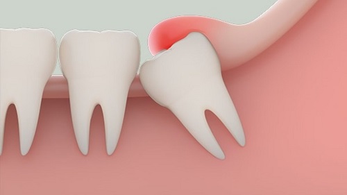 Răng khôn làm đau hàm phải xử lý ra sao? 1