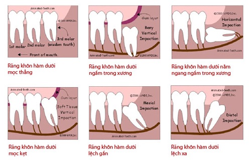 Răng khôn làm đau hàm phải xử lý ra sao? 2