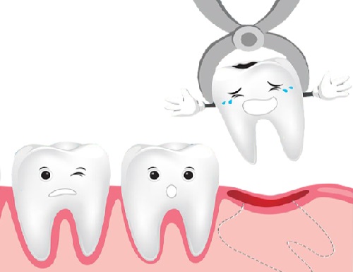 Răng khôn làm đau hàm phải xử lý ra sao? 3