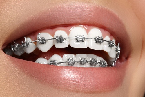 Có nên trồng răng sứ titan? Giải đáp chuyên sâu 1