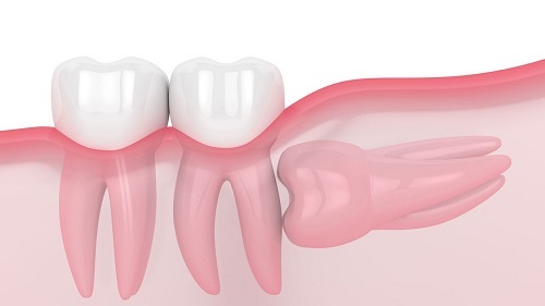 Răng khôn dị dạng - Cách khắc phục hiệu quả an toàn 1 Răng khôn dị dạng - Cách khắc phục hiệu quả an toàn 1