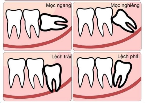 Răng khôn hàm trên mọc ngầm nên làm gì? 2
