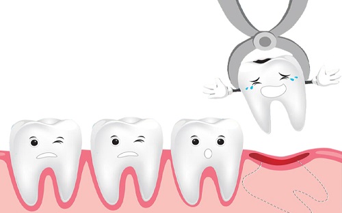 Răng khôn hàm trên bị vỡ nên xử lý ra sao? 3