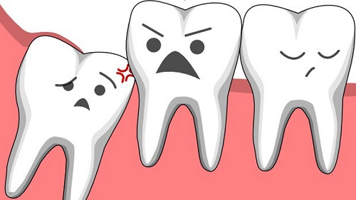 Chụp x quang răng khôn bao nhiêu tiền? Tham khảo 1