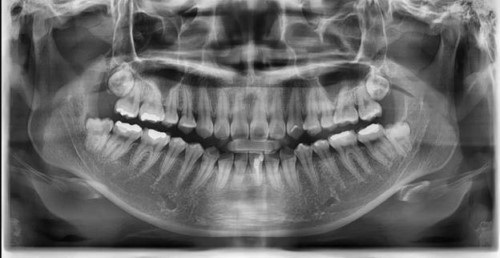 Chụp x quang răng khôn bao nhiêu tiền? Tham khảo 2