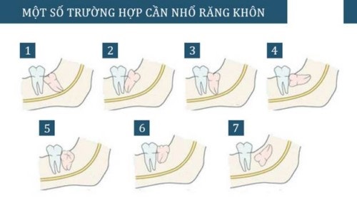 Răng khôn hàm trên bị vỡ nên xử lý ra sao? 1 Răng khôn hàm trên bị vỡ nên xử lý ra sao? 1