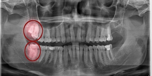 Răng khôn hàm trên bị vỡ nên xử lý ra sao? 1