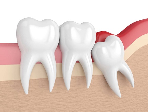 Đau răng khôn dẫn đến đau tai phải làm sao? 1 Đau răng khôn dẫn đến đau tai phải làm sao? 1