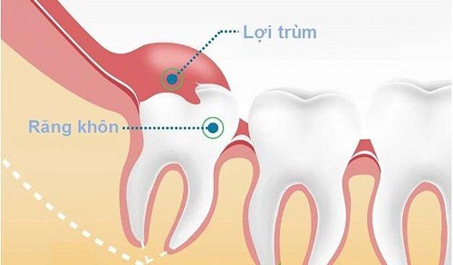 Đau răng khôn dẫn đến đau tai phải làm sao? 2