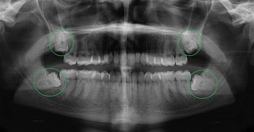 Đau răng khôn dẫn đến đau tai phải làm sao? 3