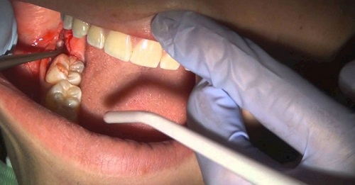 Viêm ổ răng khôn chữa thế nào? 2
