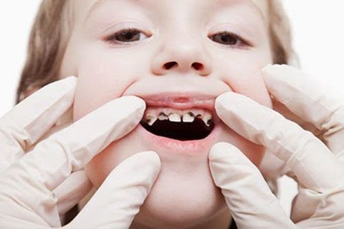 Quy trình điều trị tủy răng sữa cho trẻ em 1