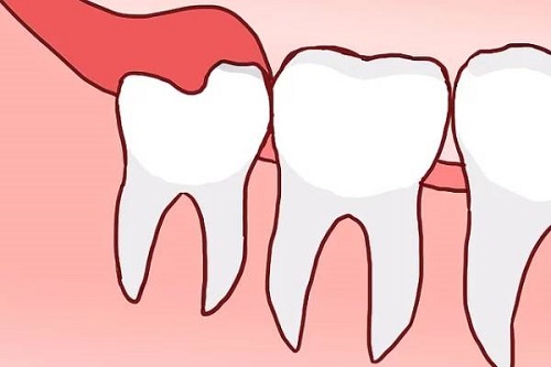 Mọc răng khôn nuốt nước bọt đau - Xử lý dứt điểm 2