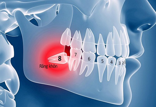 Răng khôn nguy hiểm như thế nào? Tìm hiểu tại nha khoa 1
