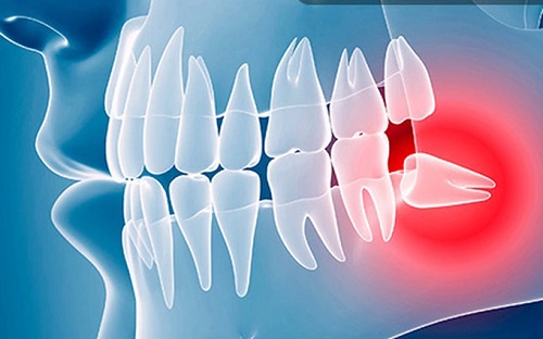 Răng khôn nguy hiểm như thế nào? Tìm hiểu tại nha khoa 2